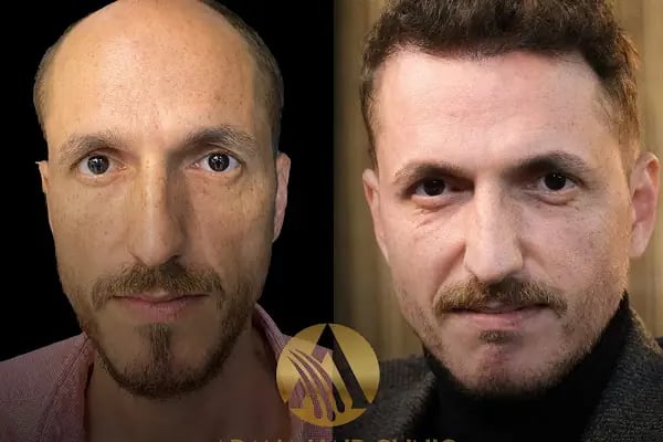 Simya Saç Ekimi &amp; Güzellik Merkezi - Hair Transplant Clinic in Turkey - Resim 10