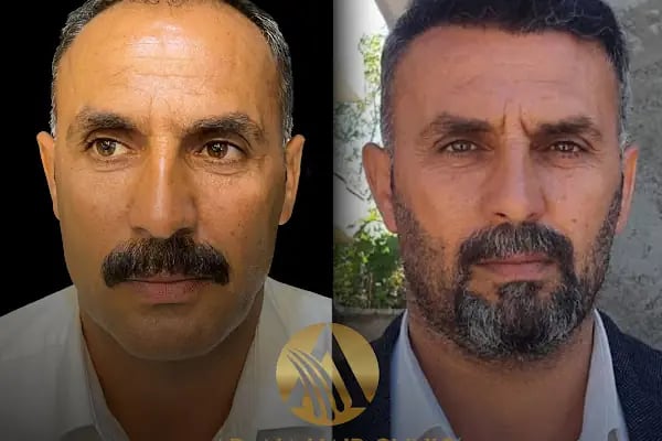 Simya Saç Ekimi &amp; Güzellik Merkezi - Hair Transplant Clinic in Turkey - Resim 1