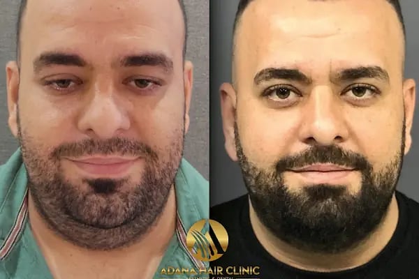 Simya Saç Ekimi &amp; Güzellik Merkezi - Hair Transplant Clinic in Turkey - Resim 15