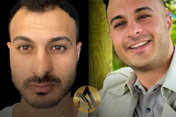 Simya Saç Ekimi &amp; Güzellik Merkezi - Hair Transplant Clinic in Turkey - Resim 12