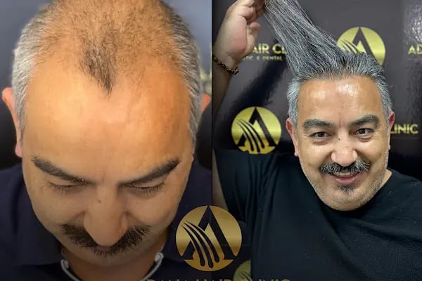Simya Saç Ekimi &amp; Güzellik Merkezi - Hair Transplant Clinic in Turkey - Resim 14