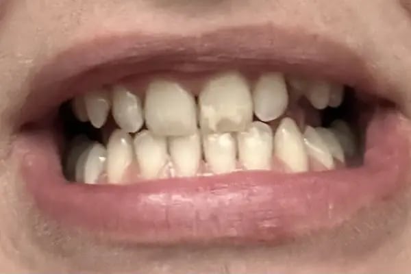 Bursa Diş Hekimi Fatih Ay | implant | Gülüş Tasarımı | Dentist - Resim 13