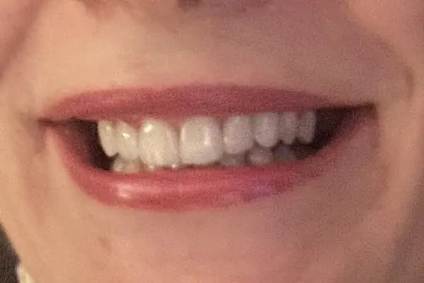 Bursa Diş Hekimi Fatih Ay | implant | Gülüş Tasarımı | Dentist - Resim 8