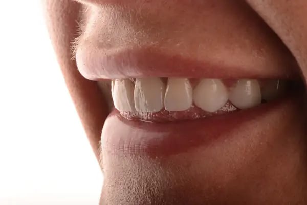 Bursa Diş Hekimi Fatih Ay | implant | Gülüş Tasarımı | Dentist - Resim 11