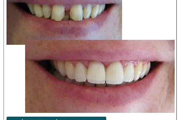 Dr. Dt. Kerem Aras - Protez Uzmanı - Ümitköy Zirkon İmplant Estetik Ortodonti - Resim 20