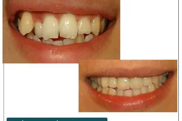 Dr. Dt. Kerem Aras - Protez Uzmanı - Ümitköy Zirkon İmplant Estetik Ortodonti - Resim 15