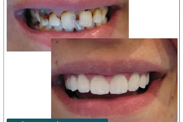 Dr. Dt. Kerem Aras - Protez Uzmanı - Ümitköy Zirkon İmplant Estetik Ortodonti - Resim 19