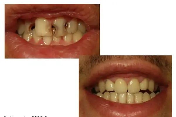 Dr. Dt. Kerem Aras - Protez Uzmanı - Ümitköy Zirkon İmplant Estetik Ortodonti - Resim 10