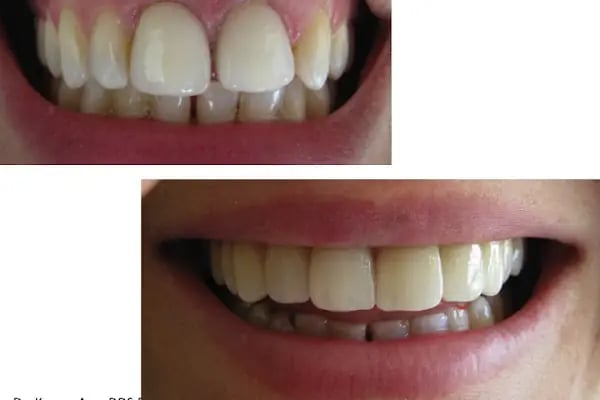 Dr. Dt. Kerem Aras - Protez Uzmanı - Ümitköy Zirkon İmplant Estetik Ortodonti - Resim 17