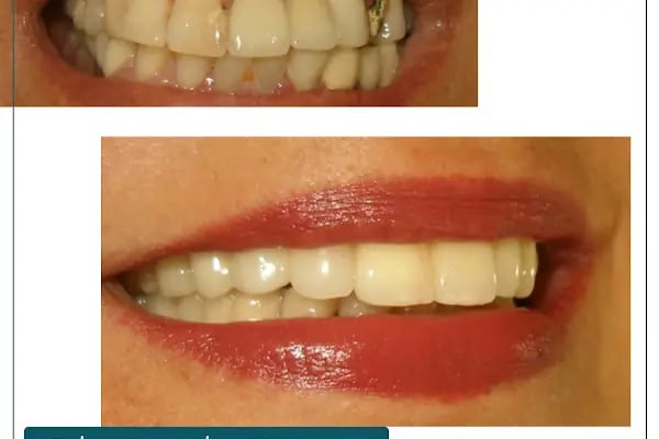 Dr. Dt. Kerem Aras - Protez Uzmanı - Ümitköy Zirkon İmplant Estetik Ortodonti - Resim 13