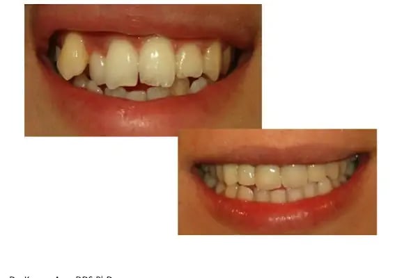 Dr. Dt. Kerem Aras - Protez Uzmanı - Ümitköy Zirkon İmplant Estetik Ortodonti - Resim 16