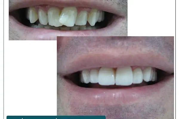 Dr. Dt. Kerem Aras - Protez Uzmanı - Ümitköy Zirkon İmplant Estetik Ortodonti - Resim 14