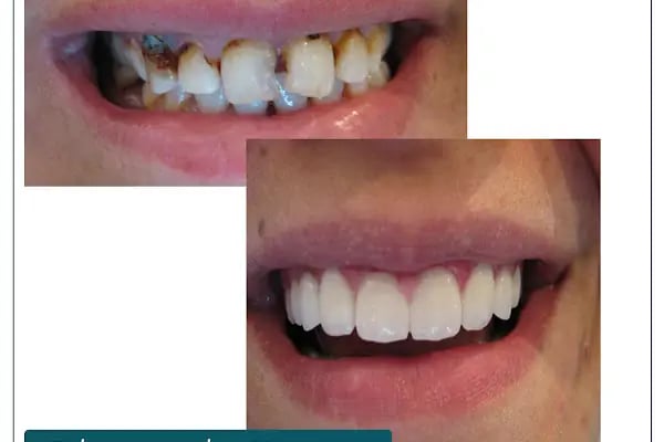 Dr. Dt. Kerem Aras - Protez Uzmanı - Ümitköy Zirkon İmplant Estetik Ortodonti - Resim 18