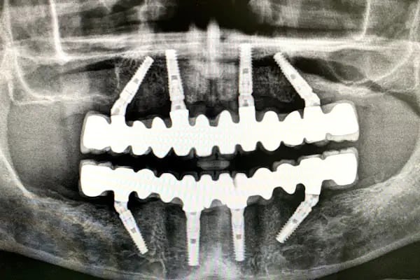BULUT DENTAL DİŞ POLİKLİNİĞİ (İMPLANT ve ORTODONTİ KLİNİĞİ) - Resim 14