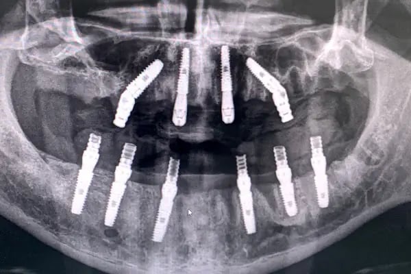 BULUT DENTAL DİŞ POLİKLİNİĞİ (İMPLANT ve ORTODONTİ KLİNİĞİ) - Resim 11