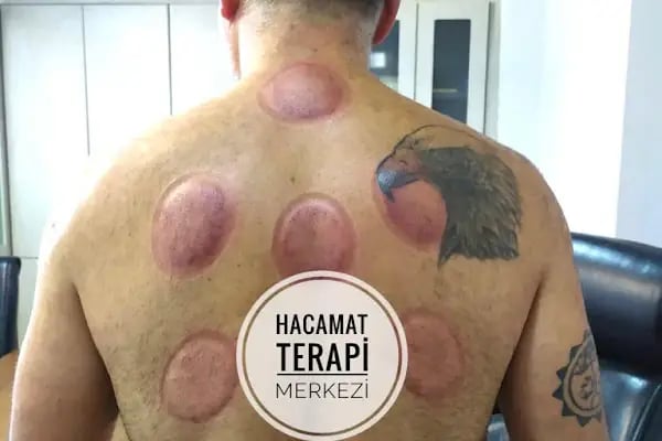 Hacamat Terapi Merkezi / Hacamat ve Sülük Tedavisi - Resim 11
