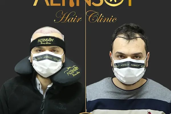 Trabzon Saç Ekim Merkezi Saç PRP`si | Altınsoy Hair Clinic - Resim 10