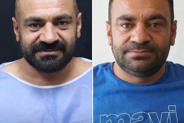 Trabzon Saç Ekim Merkezi Saç PRP`si | Altınsoy Hair Clinic - Resim 8