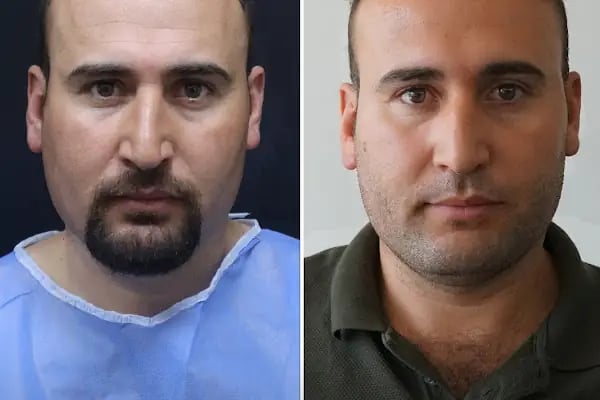 Trabzon Saç Ekim Merkezi Saç PRP`si | Altınsoy Hair Clinic - Resim 11