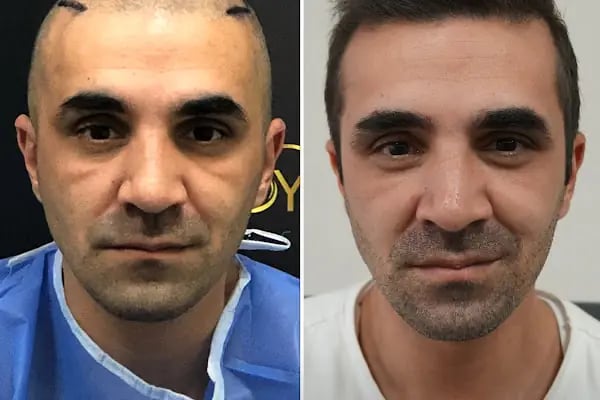 Trabzon Saç Ekim Merkezi Saç PRP`si | Altınsoy Hair Clinic - Resim 1