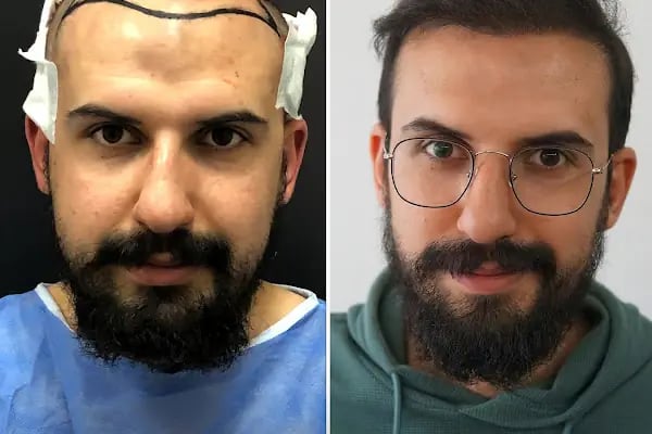 Trabzon Saç Ekim Merkezi Saç PRP`si | Altınsoy Hair Clinic - Resim 12