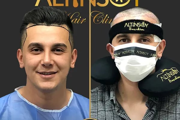 Trabzon Saç Ekim Merkezi Saç PRP`si | Altınsoy Hair Clinic - Resim 2