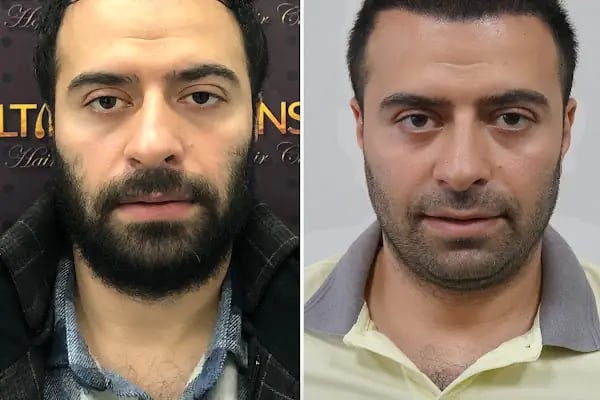Trabzon Saç Ekim Merkezi Saç PRP`si | Altınsoy Hair Clinic - Resim 15