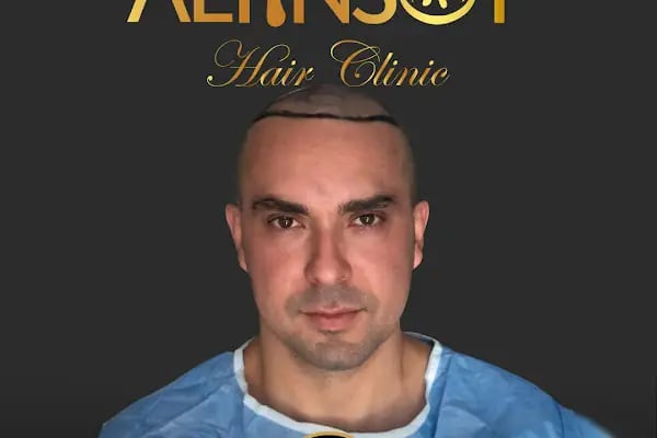 Trabzon Saç Ekim Merkezi Saç PRP`si | Altınsoy Hair Clinic - Resim 5