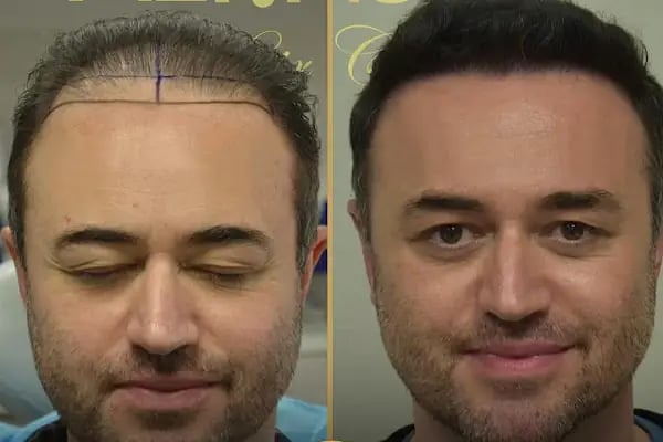 Trabzon Saç Ekim Merkezi Saç PRP`si | Altınsoy Hair Clinic - Resim 17