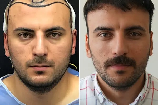 Trabzon Saç Ekim Merkezi Saç PRP`si | Altınsoy Hair Clinic - Resim 14