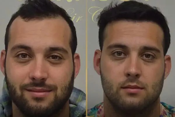 Trabzon Saç Ekim Merkezi Saç PRP`si | Altınsoy Hair Clinic - Resim 18