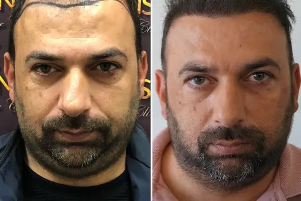 Trabzon Saç Ekim Merkezi Saç PRP`si | Altınsoy Hair Clinic - Resim 6