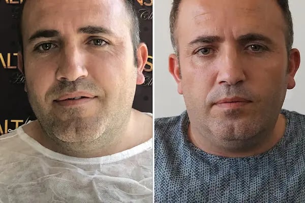 Trabzon Saç Ekim Merkezi Saç PRP`si | Altınsoy Hair Clinic - Resim 7