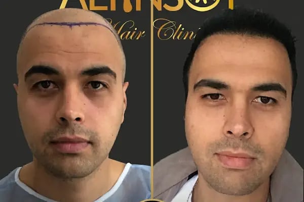 Trabzon Saç Ekim Merkezi Saç PRP`si | Altınsoy Hair Clinic - Resim 3