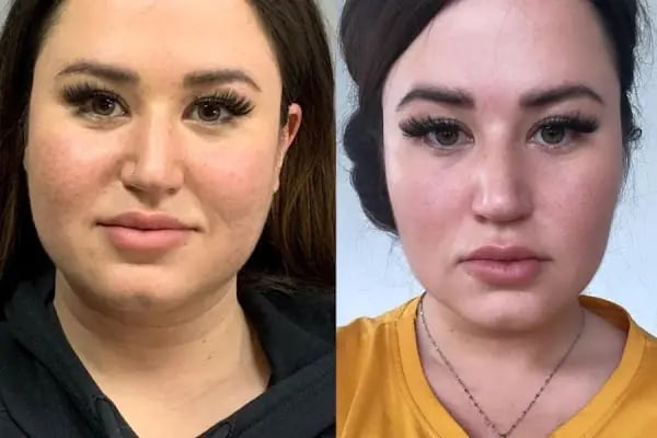 Burun Estetiği- Liposuction- Meme Estetiği-Karın germe -Op.Dr Ekrem KESKİN - Resim 16