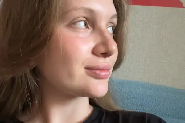 Best Rhinoplasty Surgeon in Turkey | Op. Dr. Cem Altındağ İstanbul - Resim 12