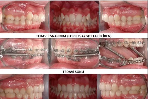 ARTI ORTODONTİ ESTETİK AĞIZ VE DİŞ SAĞLIĞI POLİKLİNİĞİ - Resim 11