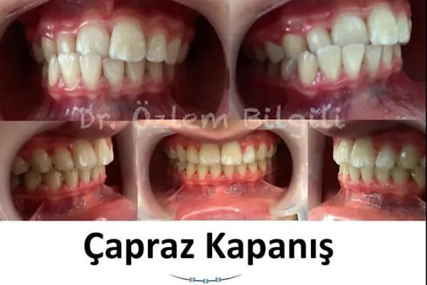 ARTI ORTODONTİ ESTETİK AĞIZ VE DİŞ SAĞLIĞI POLİKLİNİĞİ - Resim 16