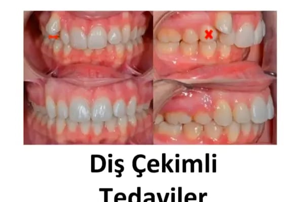 ARTI ORTODONTİ ESTETİK AĞIZ VE DİŞ SAĞLIĞI POLİKLİNİĞİ - Resim 14
