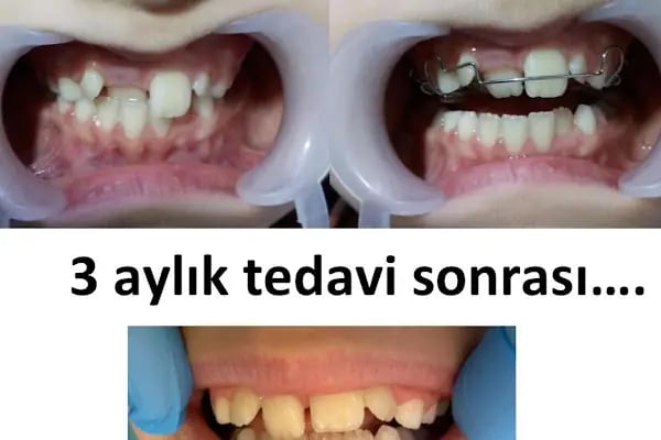 ARTI ORTODONTİ ESTETİK AĞIZ VE DİŞ SAĞLIĞI POLİKLİNİĞİ - Resim 12