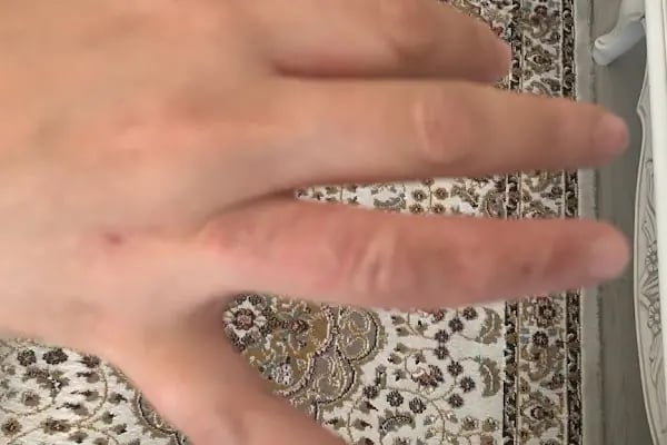 Dermatolog Prof.Dr.Rana Anadolu-Dermatolog Ankara-Dermatoloji-Dermatoloji Kliniği-Dermatoloji Uzmanı-Cilt Hekimi-Tavsiye - Resim 12