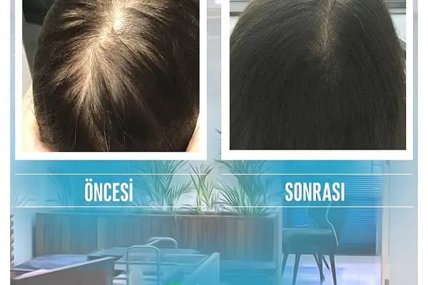 S Clinic Diyarbakır - Saç Çoğaltma, Saç Bakım ve Güzellik Merkezi - Resim 20