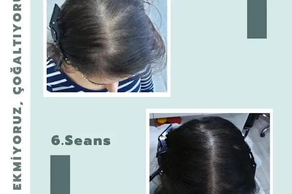 S Clinic Diyarbakır - Saç Çoğaltma, Saç Bakım ve Güzellik Merkezi - Resim 15