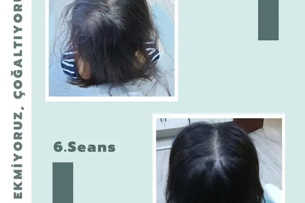 S Clinic Diyarbakır - Saç Çoğaltma, Saç Bakım ve Güzellik Merkezi - Resim 19