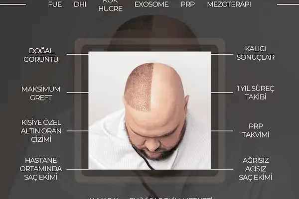Ahmet Arslan Hair Transplant - Ankara Saç Ekimi - PRP - Resim 17