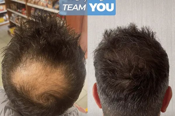 Ahmet Arslan Hair Transplant - Ankara Saç Ekimi - PRP - Resim 19