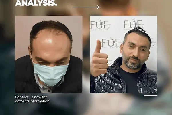Ahmet Arslan Hair Transplant - Ankara Saç Ekimi - PRP - Resim 9