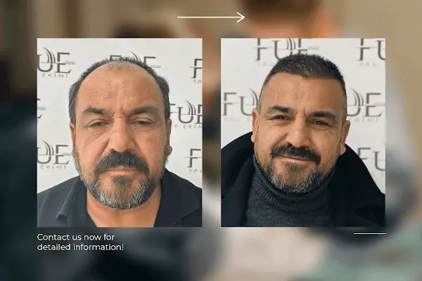 Ahmet Arslan Hair Transplant - Ankara Saç Ekimi - PRP - Resim 15