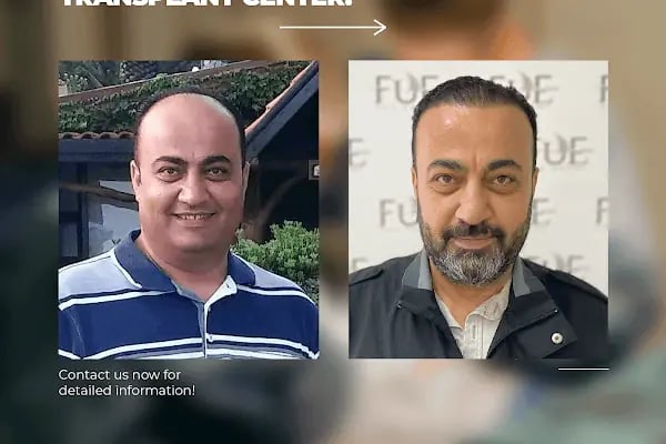 Ahmet Arslan Hair Transplant - Ankara Saç Ekimi - PRP - Resim 6