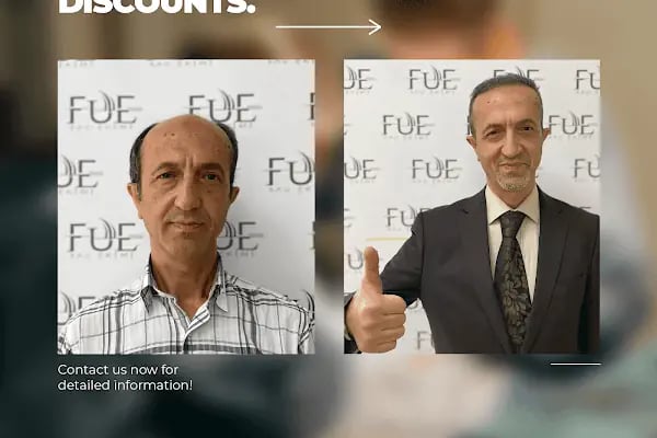 Ahmet Arslan Hair Transplant - Ankara Saç Ekimi - PRP - Resim 4